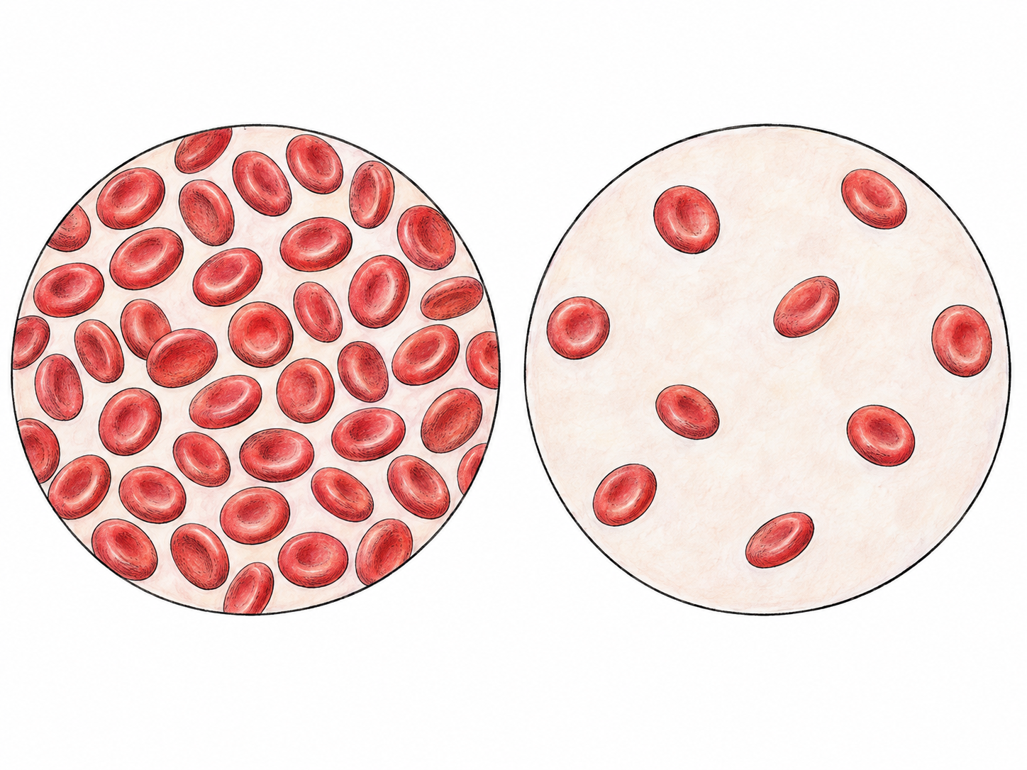 Two equal-sized, side-by-side microscopic views of blood: one contains a normal dense distribution of healthy red blood cells; the other contains markedly fewer cells in the same volume.