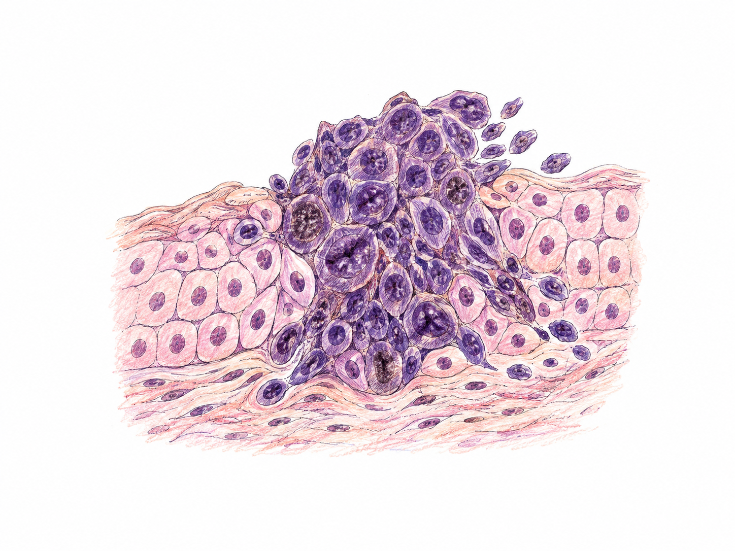Small conceptual microscopic tissue vignette: orderly pale pink cells disrupted by a compact irregular cluster of multiplying dark-purple abnormal cells pushing into neighboring tissue; hand-drawn biological illustration, no organ diagnosis, no text.